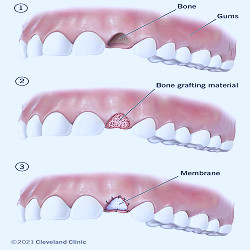 Dental Bone Graft: Process, Healing & What It Is
